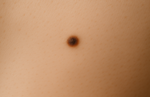 Apgamų šalinimas lazeriu: modernus sprendimas saugiai ir efektyviai