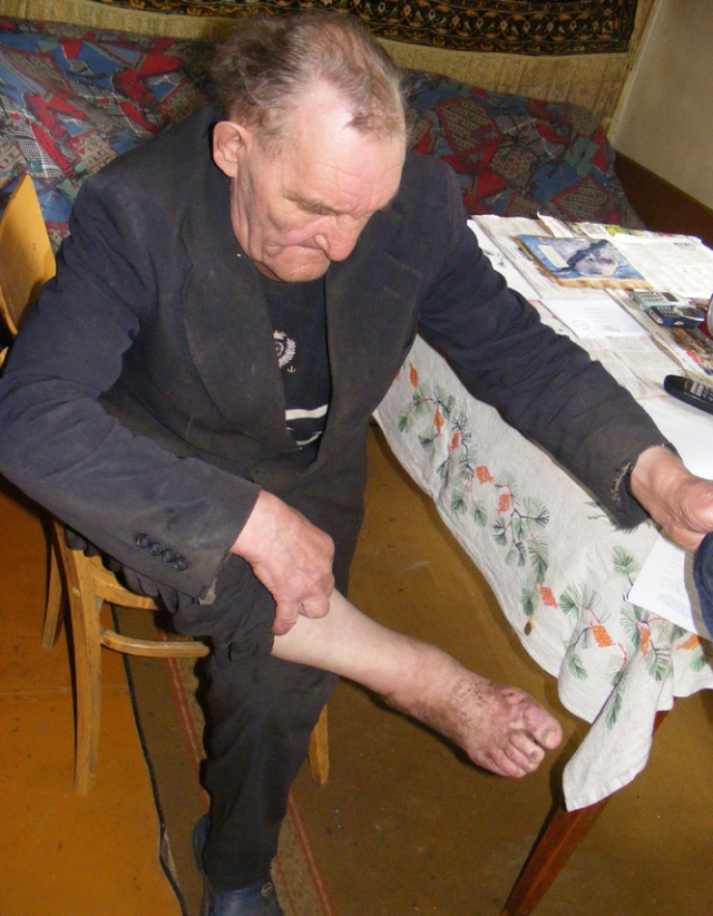 Čedasų gyventojo Eugenijaus Rudoko koja